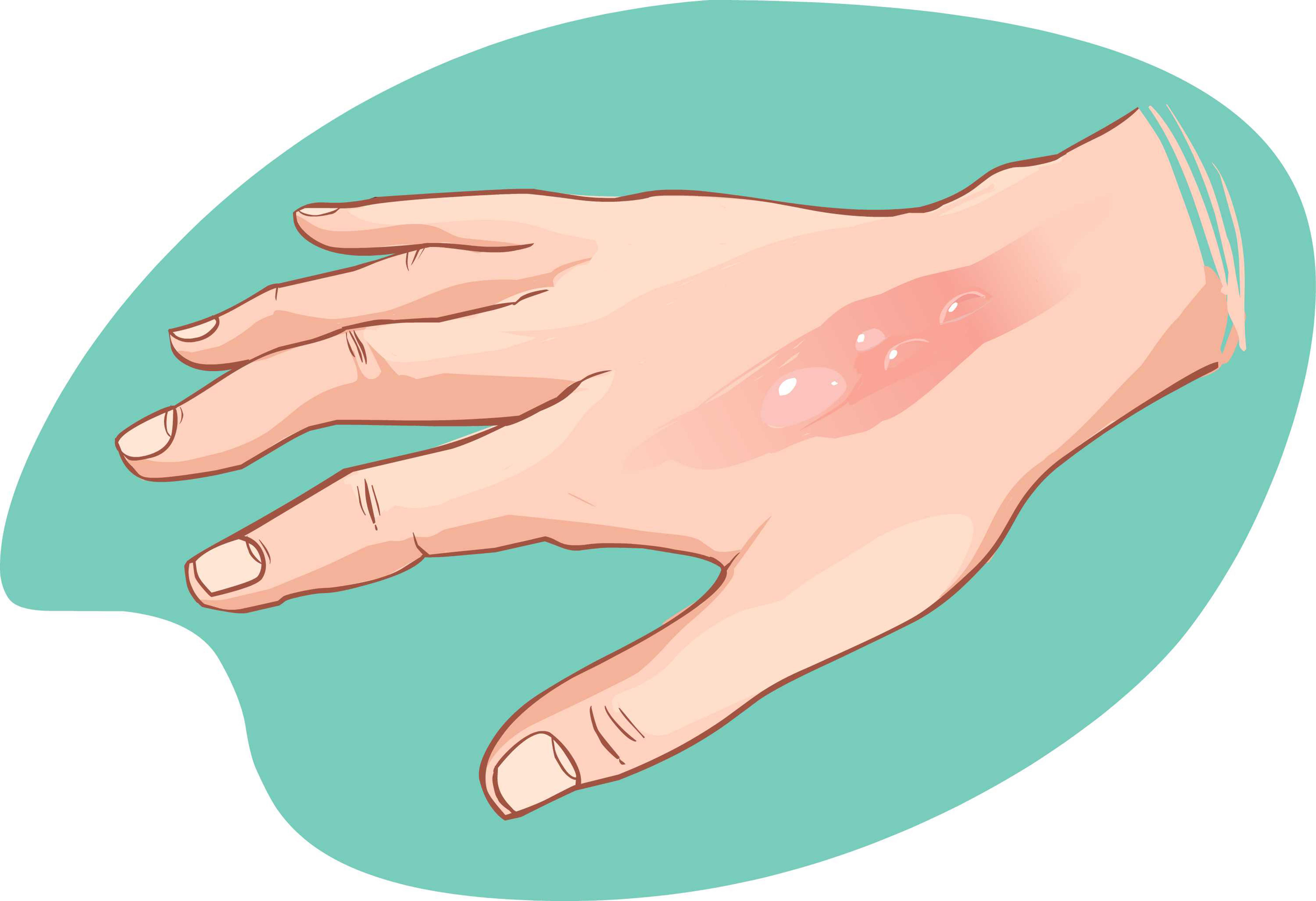 How to Treat Burn Wounds