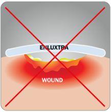 How To Use the Enluxtra Dressing?